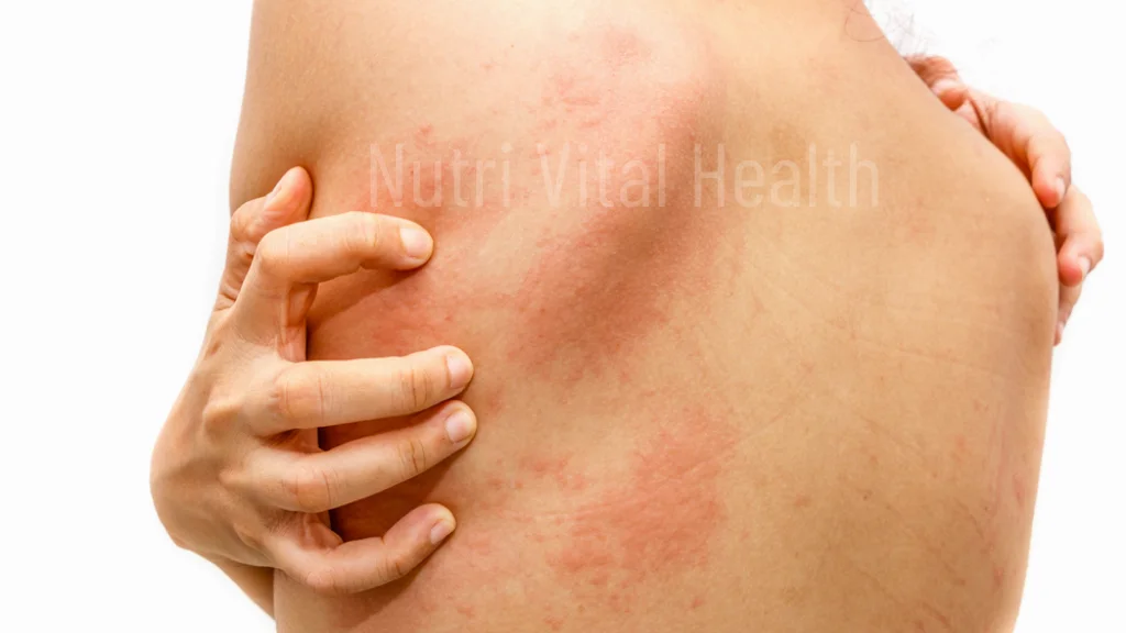 5 Ways of Preventing Skin Diseases Today