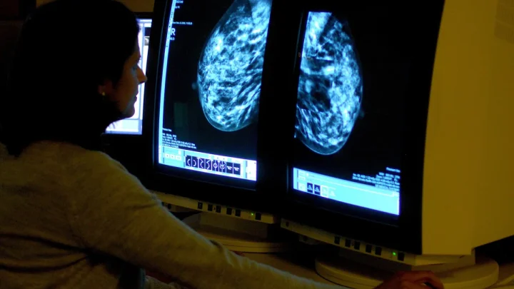 Millions of breast cancer patients could avoid chemotherapy with new genome test