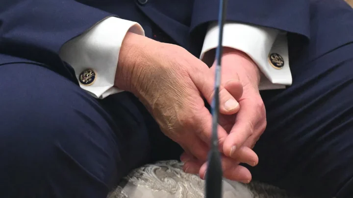 Trump’s makeup-covered bruised hand on full display as he meets with NATO leaders in Turkey